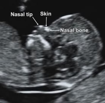 Nasal-bone