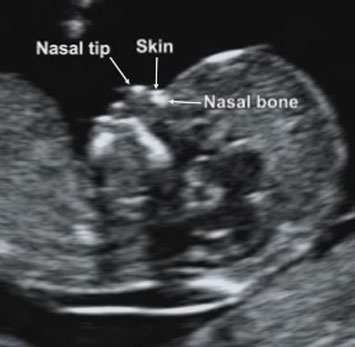 down syndrome baby ultrasound